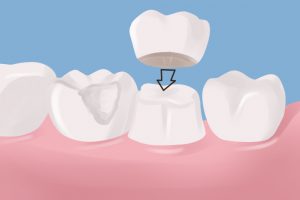 Dental Crown in Dedham