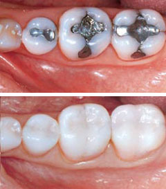 dental restoration in Dedham