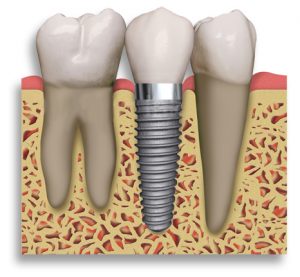 Dental Implants in Dedham